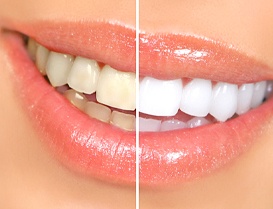 Teeth before and after teeth whitening in Arlington Heights