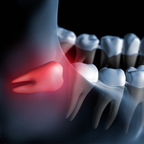 Illustrated wisdom tooth pressing against adjacent tooth