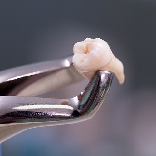 Dental forceps holding extracted tooth