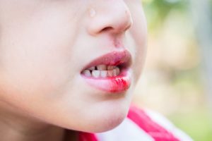 A child with a dental injury.