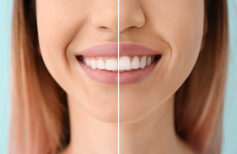 young woman smiling after gum recontouring in Arlington 