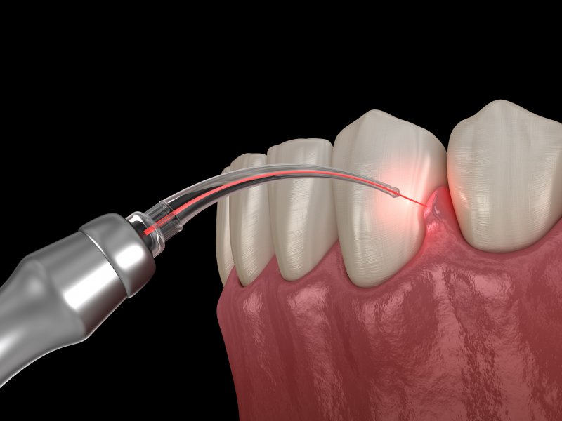 dental laser treating gum disease