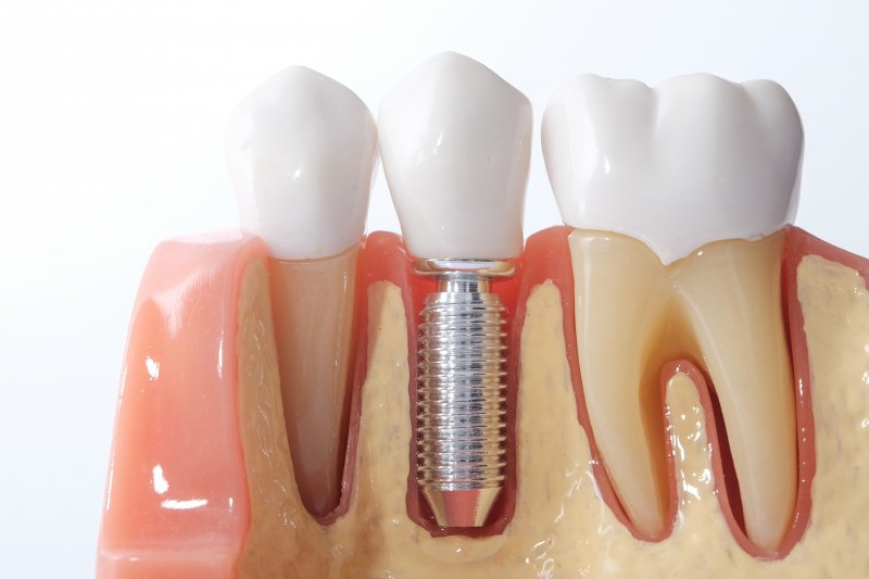 a mouth mold holding a dental implant