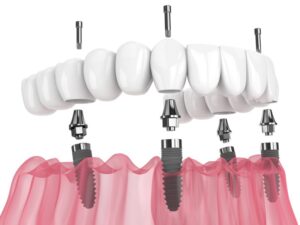 All-on-4 implants