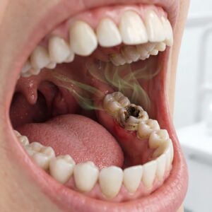 digital image of a decayed tooth and foul odor